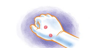 Blisters blisters - caymanhealth