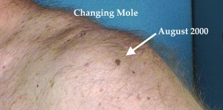 Do you know your ABCDEs?