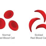 Sickle cell disease sickle cell disease