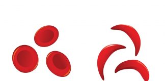 Sickle cell disease sickle cell disease